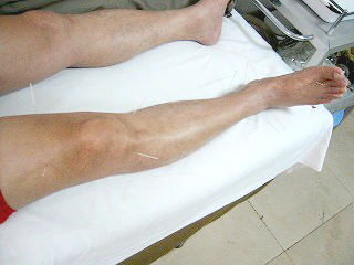 片麻痺：下肢の鍼灸治療